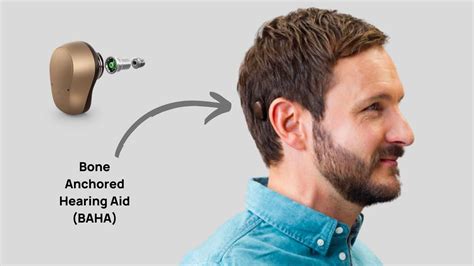 Bone Anchored Hearing Aids (BAHA) Explained - With Photos