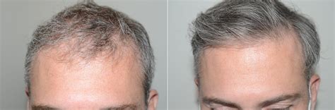 Hair Transplants for Men photos | Miami, FL | Patient123029