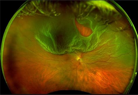 Retinal Detachment: What You Need To Know About a Detached Retina