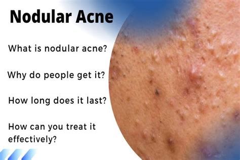 How To Get Rid Of Nodular Acne Fast - Skincare For Acne