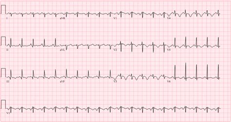 Pulmonary embolism