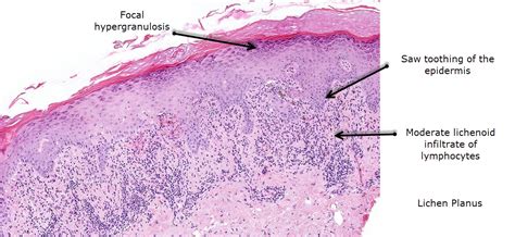 Dermatopathology Made Simple - Inflammatory: Lichenoid / Vacuolar ...