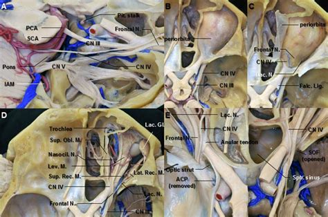 Reginal Anatomy of the Orbit and Superior Orbital Fissure ...