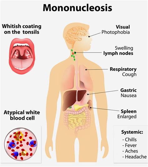 Mono In Kids: Causes, Symptoms, Treatment And Prevention