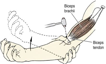 Brachioradialis Reflex