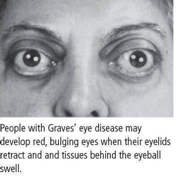 Graves' eye disease (Graves' ophthalmopathy) Guide: Causes, Symptoms ...