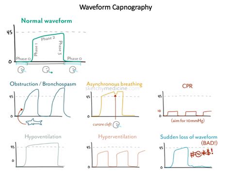 Should Waveform Capnography be in the EMT Scope of Practice? (Part 2 ...