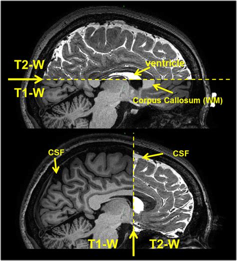 T1 And T2 Mri Signals