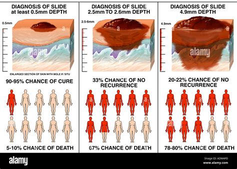 Stage 4 Melanoma Cancer