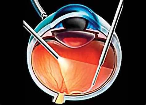 Macular Pucker Treatment | Retinal Consultants Medical Group