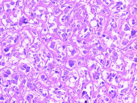 Osteosarcoma