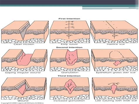 Pin by Heather Elaine on Chapter 11 Wound Healing, Sutures, Needles ...