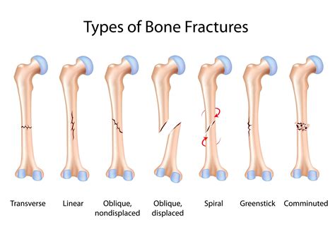 Types of Broken Bones: Symptoms, Treatment, Healing - Hernando ...