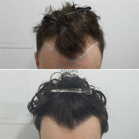 Do You Need To Take Minoxidil After A Hair Transplant?