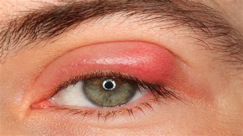 Chalazion In Eye: Causes, Surgery & Home Remedies - Health Blog