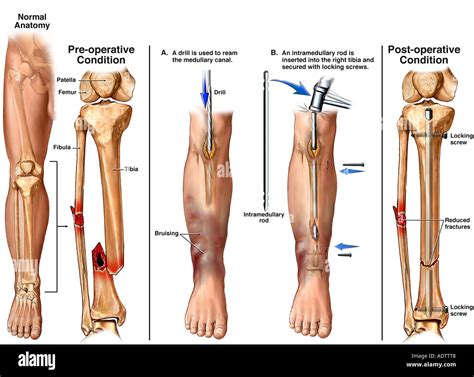 Tibia Fibula Fracture