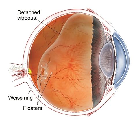 Posterior Vitreous Detachment | myeyespecialist