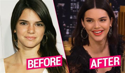 Kendall Jenner's Plastic Surgery Exposed By Top Docs