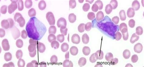 monocyte and reactive lymphocyte | Medical Laboratories