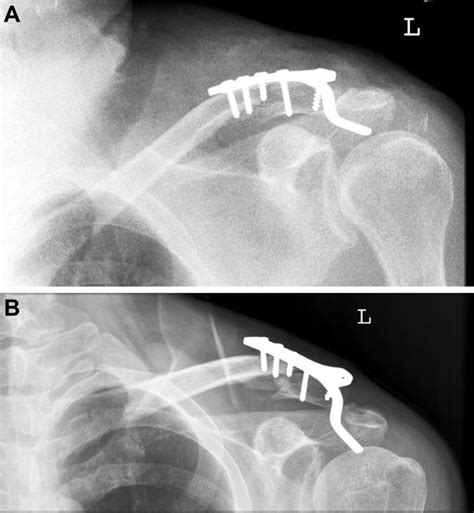 A 56 year-old man with left distal clavicle fracture was treated with ...