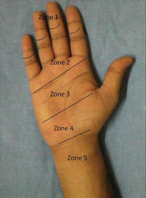 Flexor Tendon Injuries - Hand - Orthobullets