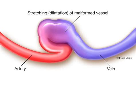 Dialysis Fistula Diagram