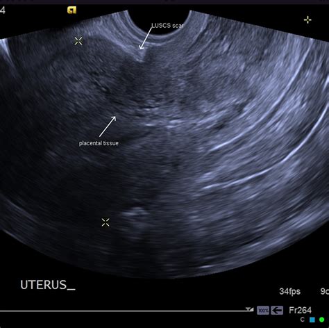 Placenta Accreta - Causes, Symptoms, Diagnosis, Risk Factors, Treatment