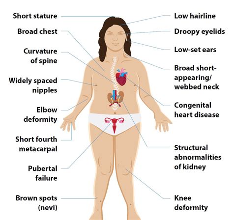 Turner Syndrome Chest