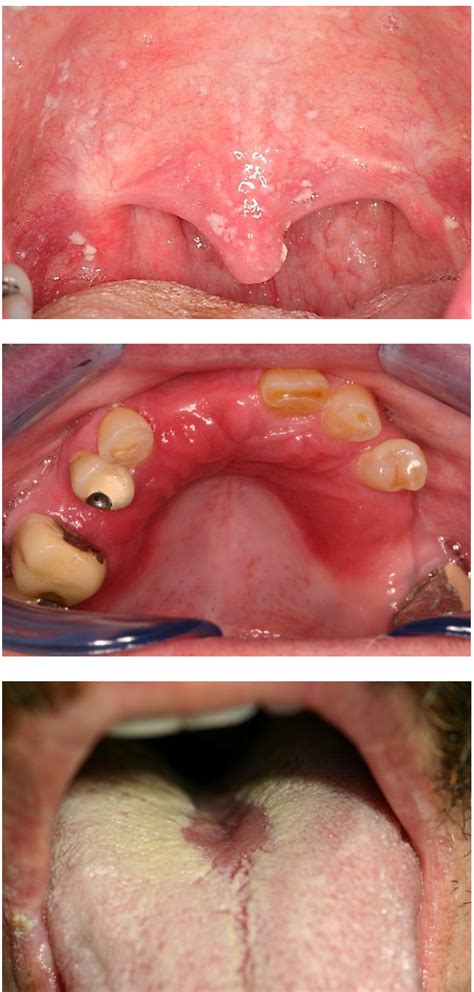 Benign Infectious Lesions/Conditions of the Oral Mucous Membrane ...