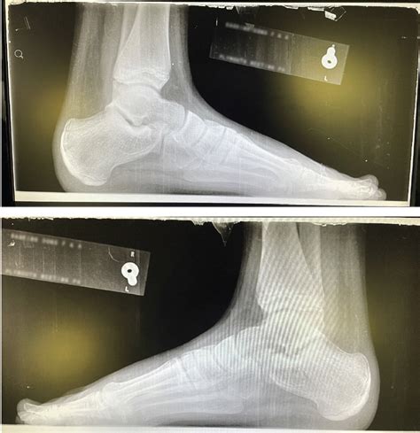 Treating Calcaneal Apophysitis