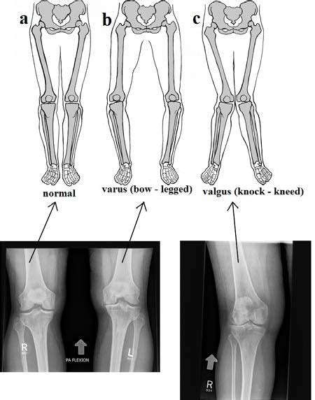 The images show a normal knee alignment (a), varus (bowed legs) (b) and ...