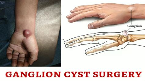 Ganglion cyst surgery (Ganglionectomy) - YouTube