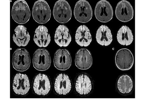 MRI in three consecutive patients with hypoglycemic encephalopathy ...