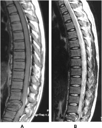 A: T2-weighted MRI image showing wedge compression fracture of L1 ...