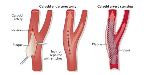 Carotid Endarterectomy Shunt