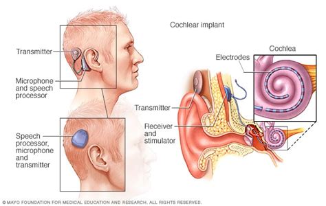 Cochlear implants - Mayo Clinic