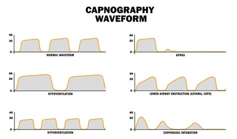 52 Capnography Royalty-Free Photos and Stock Images | Shutterstock