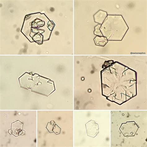 What are the types of Crystals found in Urine?