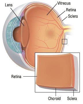 Choroidal Melanoma Guide: Causes, Symptoms and Treatment Options