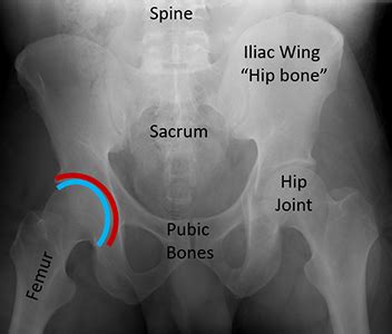 Posterior Wall Acetabular Fracture (Broken Hip Socket) | Orthopaedic ...