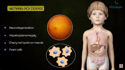 Lysosomal Storage Diseases : Quick review Medical biochemistry - YouTube