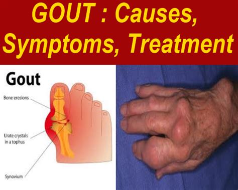 1 of th Best of: GOUT : Causes, Symptoms, Treatment