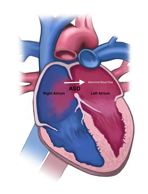 Atrial Septal Defect Rims