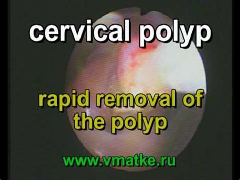 Rapid Removal of The Cervical Polyp