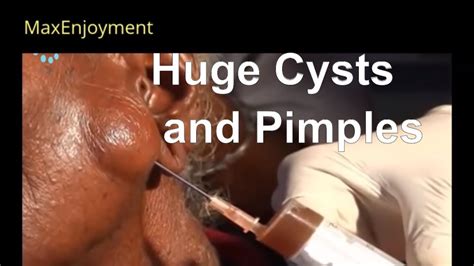 Zit / cyst popping - Pimple Popping Videos