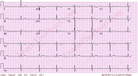 Sinus Bradycardia ECG (Example 4) | Learn the Heart