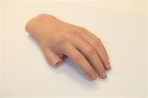 Finger and Partial Hand Prosthetic Options | Arm Dynamics