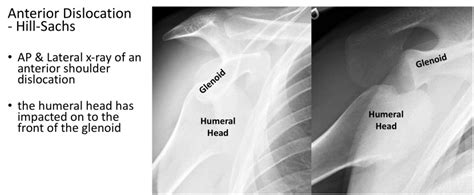 Fig 13. Traumatic Anterior Dislocation - x-ray of an anterior ...