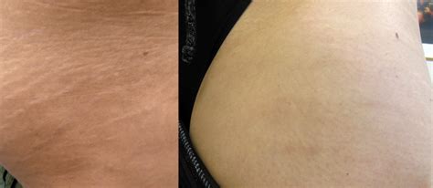 Stretch Mark Removal | London Premier Laser