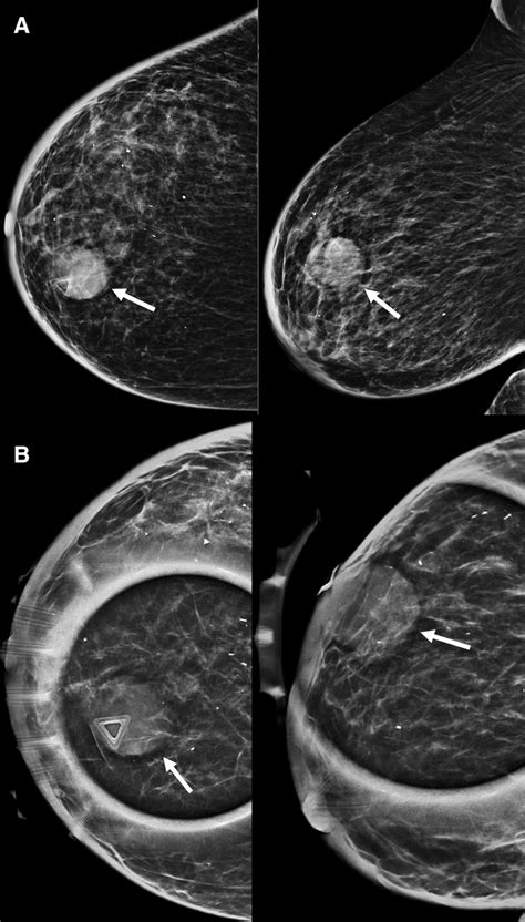 Mammogram of the right breast (A) with tomosynthesis spot compression ...